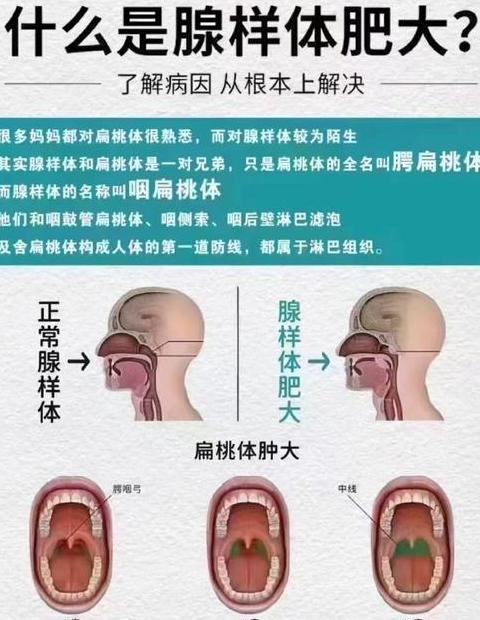 腺样体肥大：成因、症状及治疗方法全解析