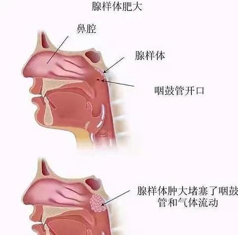 腺样体肥大70%要不要手术