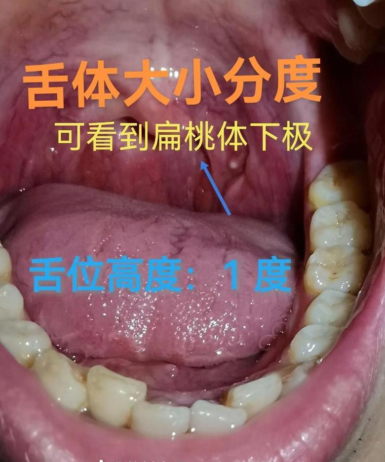 儿童腺样体肥大症状及护理方法
