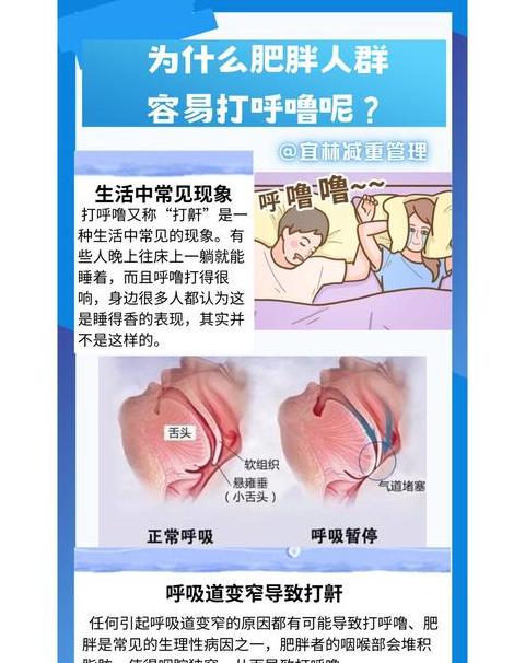 肥胖打呼噜治疗攻略：原因、症状及解决方案