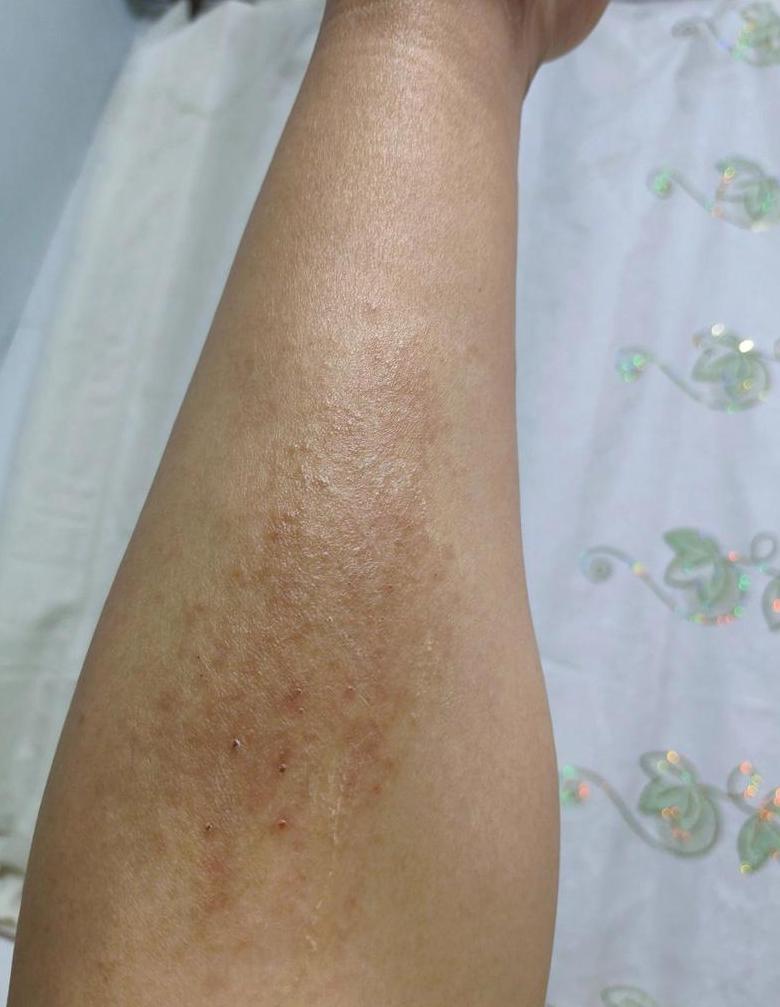 皮肤一抓就红：荨麻疹与皮肤划痕症解析及治疗