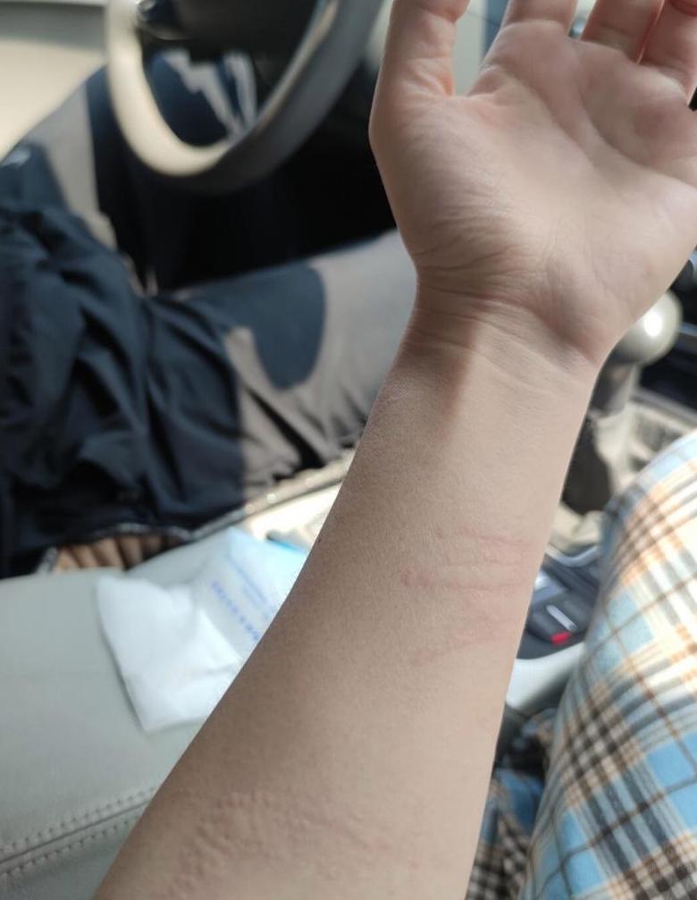 大腿内侧奇痒难耐，抓痕红印困扰多年？揭秘原因与解决方法