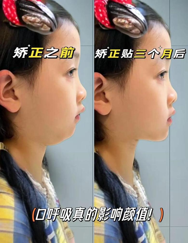 儿童腺样体面容矫正方法与时机