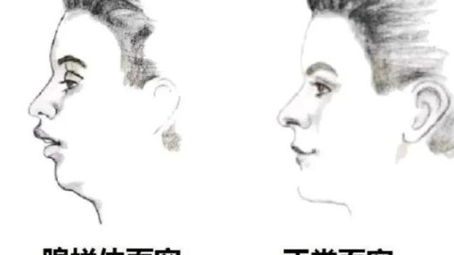 腺样体嘴唇变厚还能变回来吗