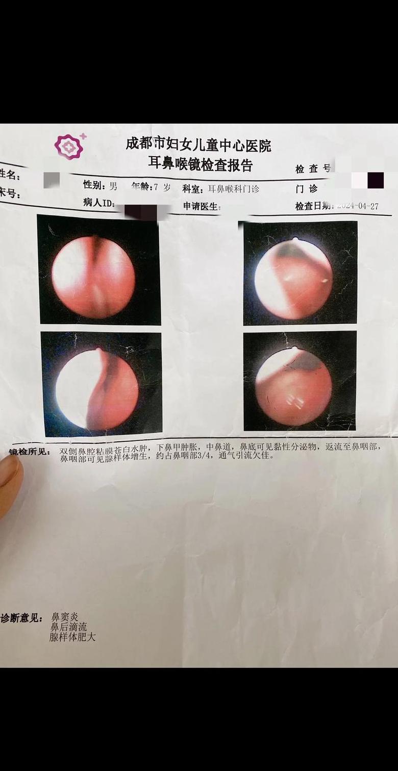 腺样体肥大：手术治疗的必要条件是什么？